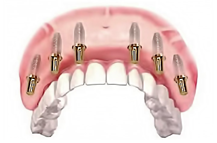 Keramički most na implantatima - Svi zubi