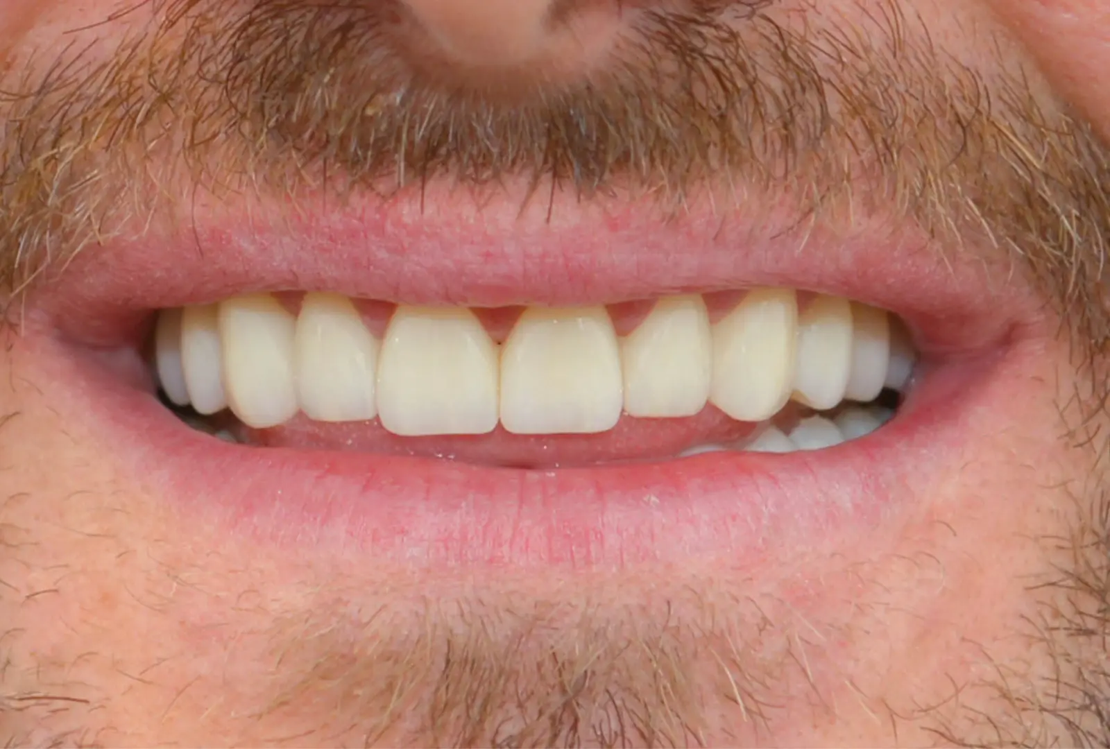 Correzione estetica dei denti: corone in piena forma di ceramica (sopra e sotto) - dopo