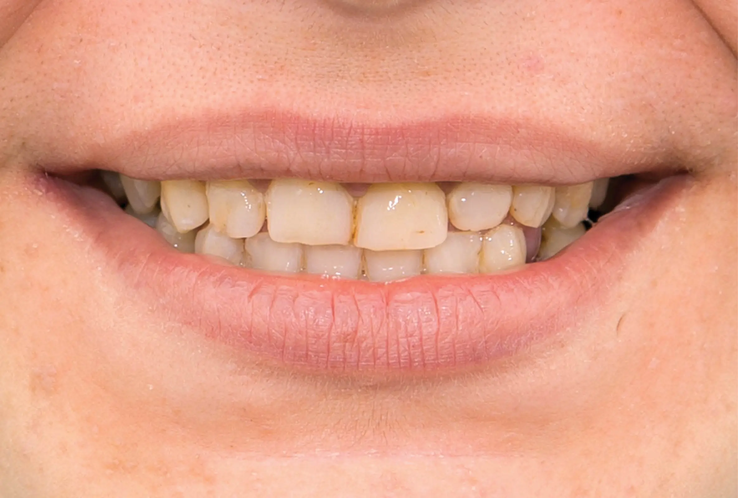 Correzione estetica dei denti: corone in piena forma di zirconio (sopra e sotto) - prima