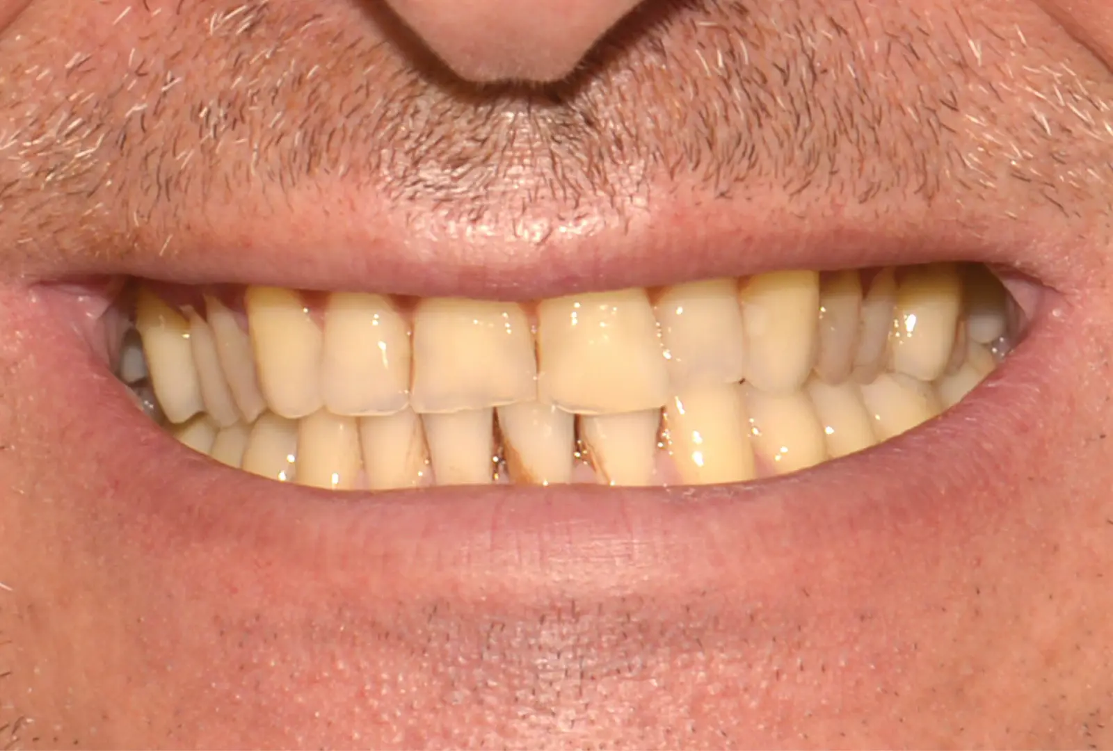 Correzione estetica dei denti: corone in piena forma di zirconio (sopra e sotto) - prima