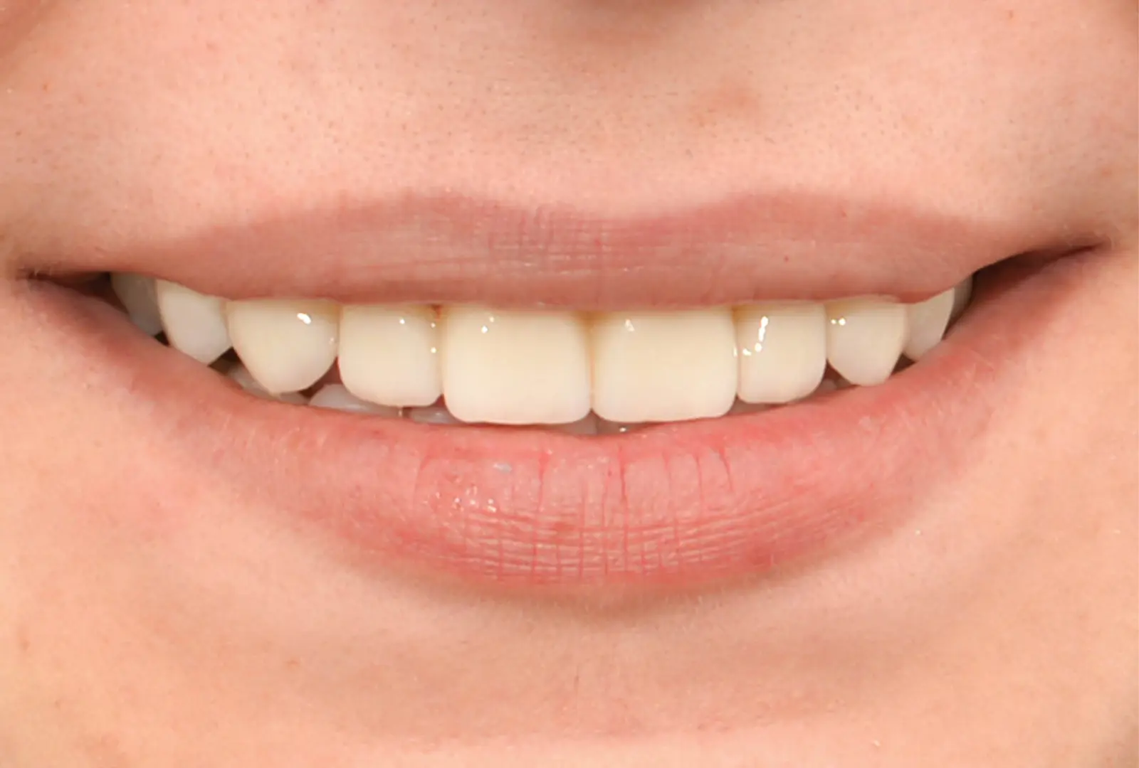 Correzione estetica dei denti: corone in piena forma di zirconio (sopra e sotto) - dopo