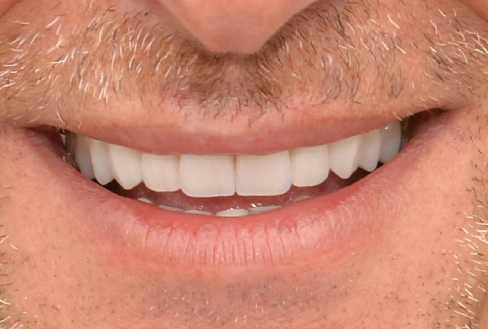 Correzione estetica dei denti: corone in piena forma di zirconio (sopra e sotto) - dopo