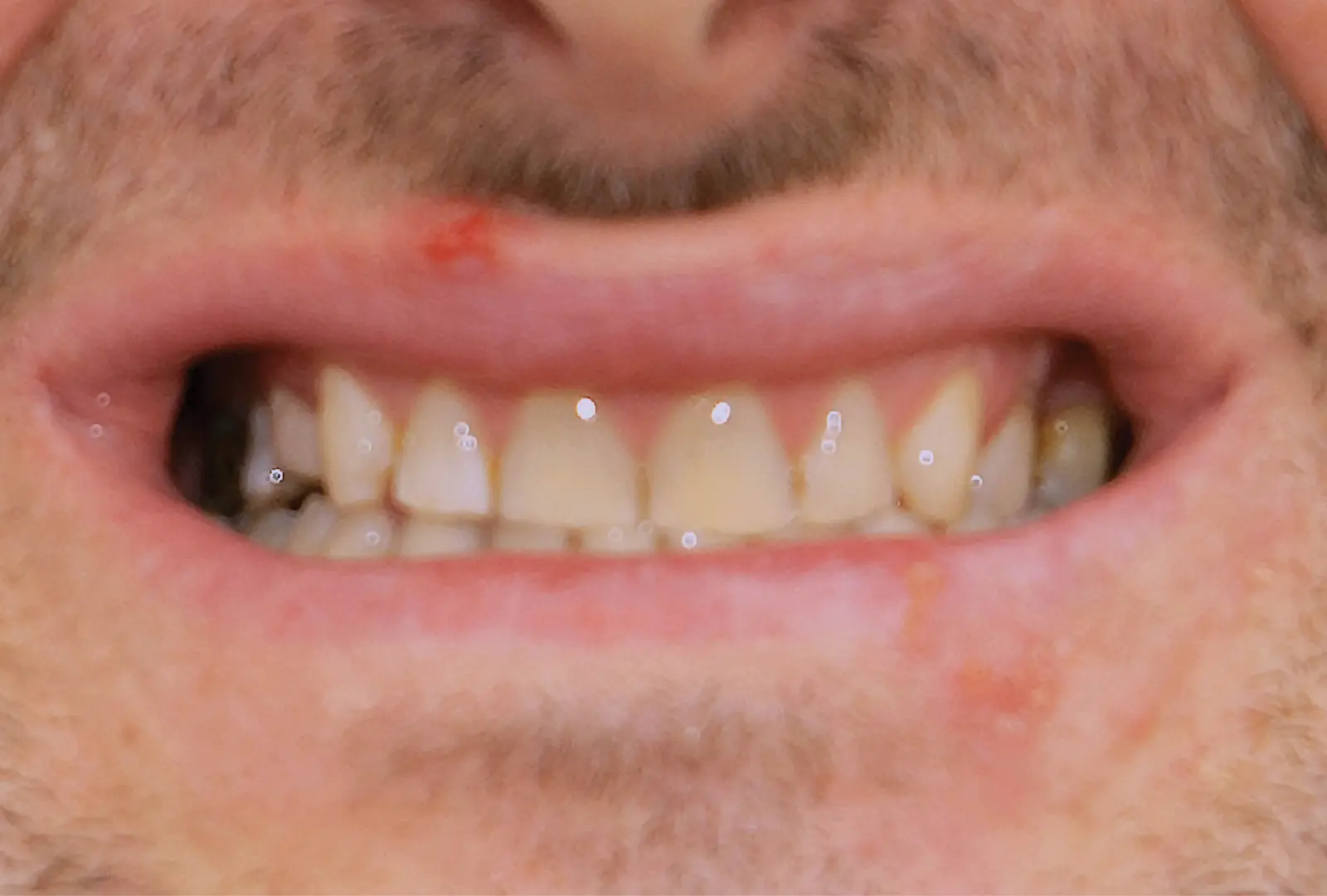 Correzione estetica dei denti: corone in piena forma di ceramica (sopra e sotto) - prima