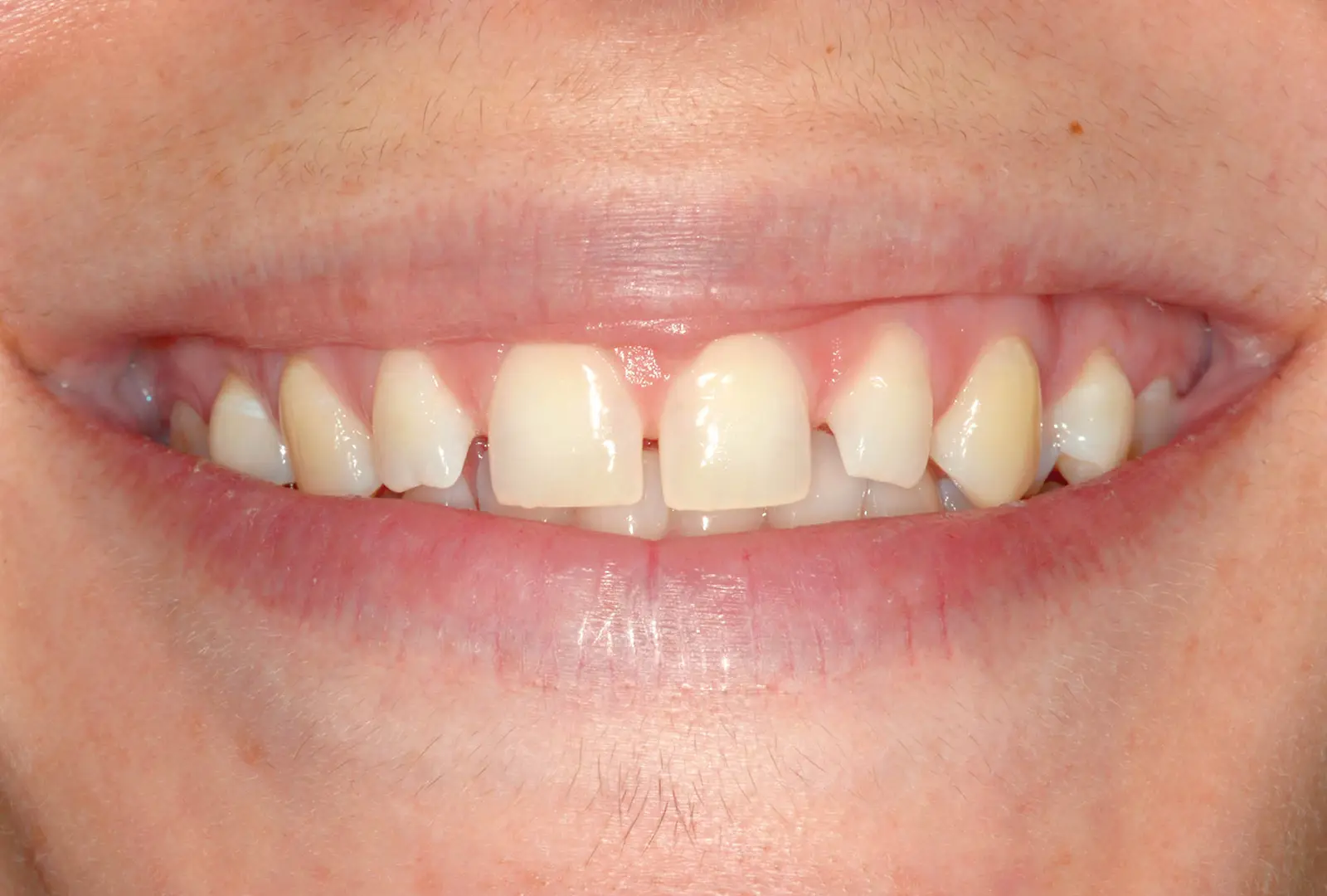Correzione estetica dei denti: facette (sopra) - prima