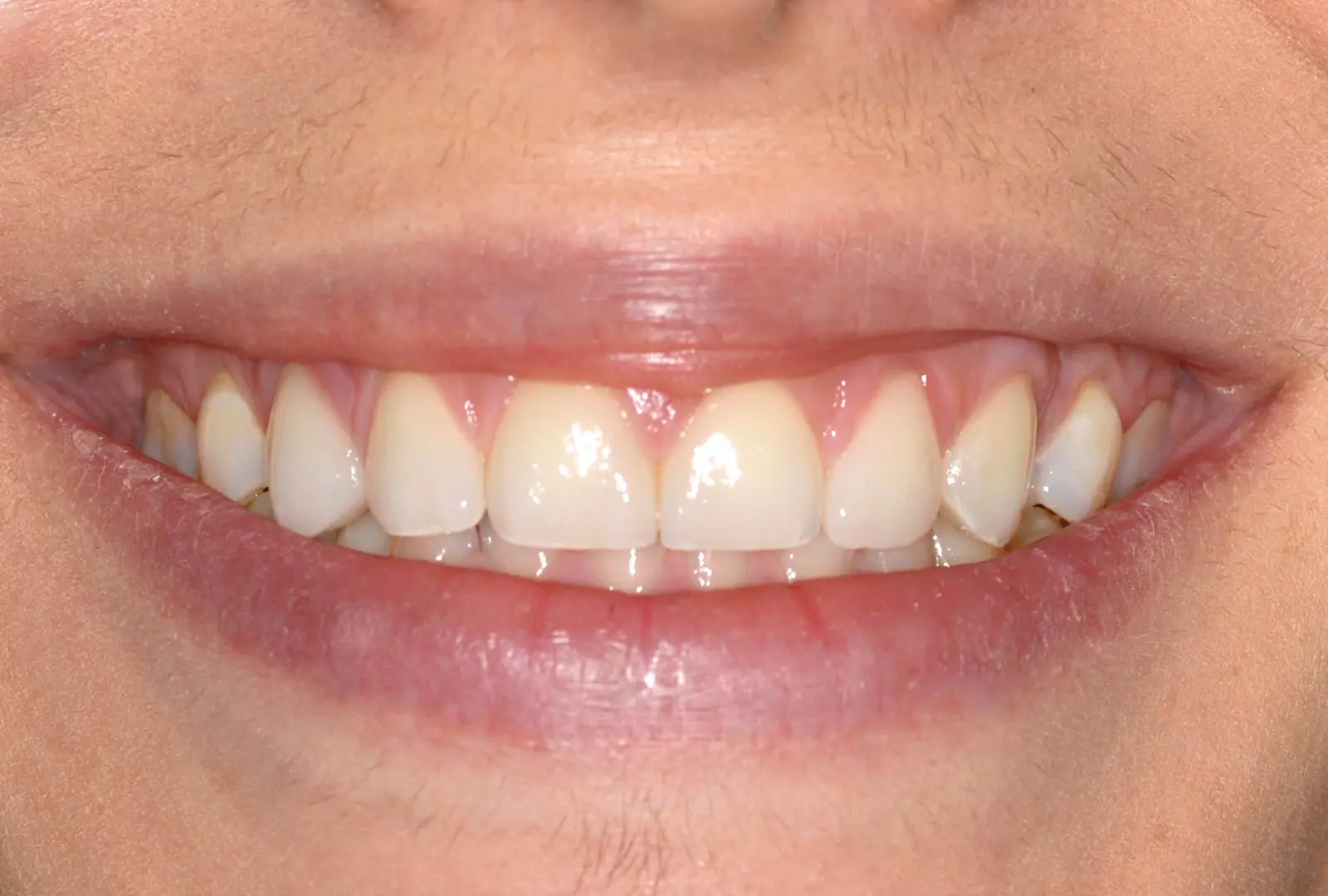 Correzione estetica dei denti: facette (sopra) - dopo