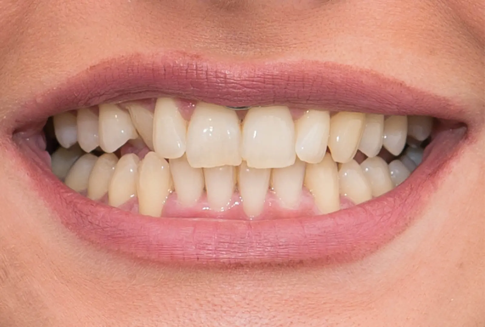 Correzione estetica del dente: corona in piena forma di ceramica (sopra) - prima
