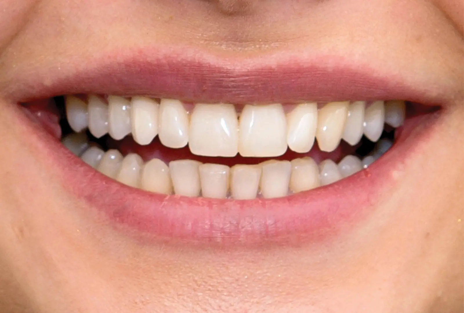 Correzione estetica del dente: corona in piena forma di ceramica (sopra) - dopo