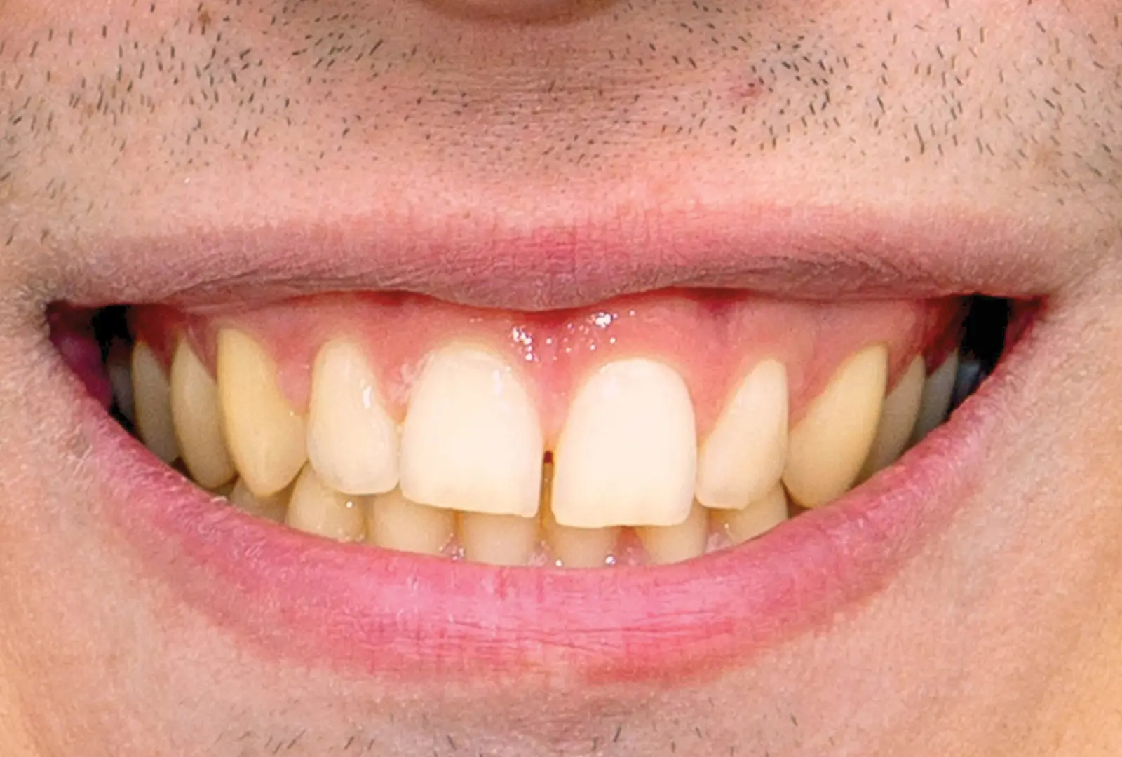 Correzione estetica dei denti: faccette in composito (sopra) - prima