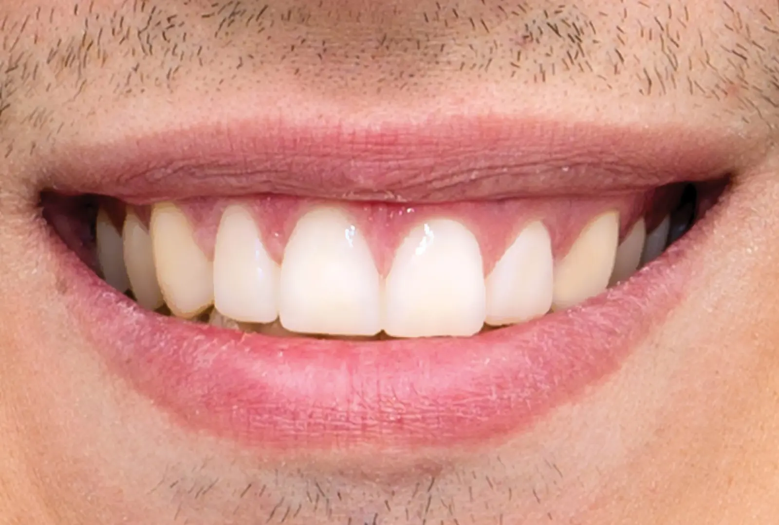 Correzione estetica dei denti: faccette in composito (sopra) - dopo