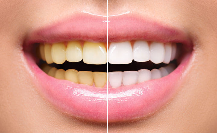 tooth whitening