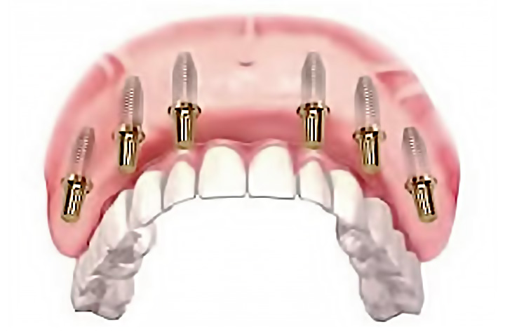 Ceramic bridge on implants - all