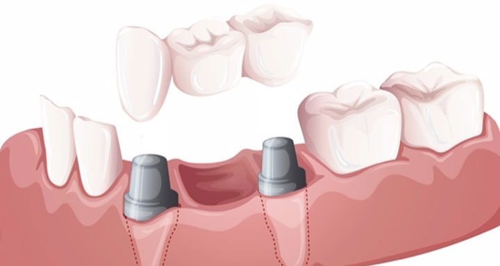 A ceramic bridge on implants