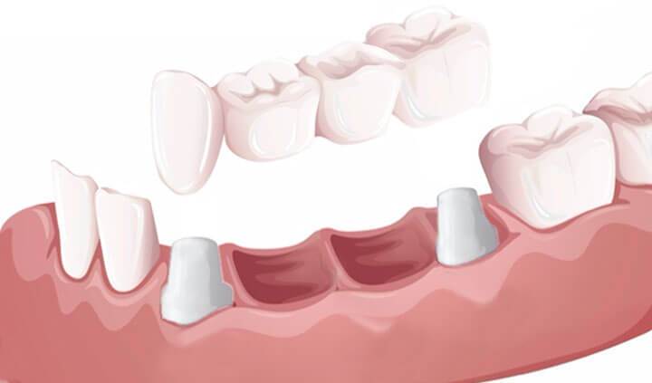 Ponte in ceramica su denti naturali