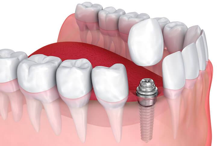 A crown on an implant