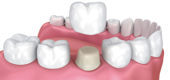 Corona su dente naturale