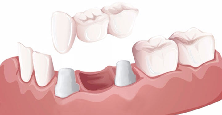 Three-component (crowns) bridge