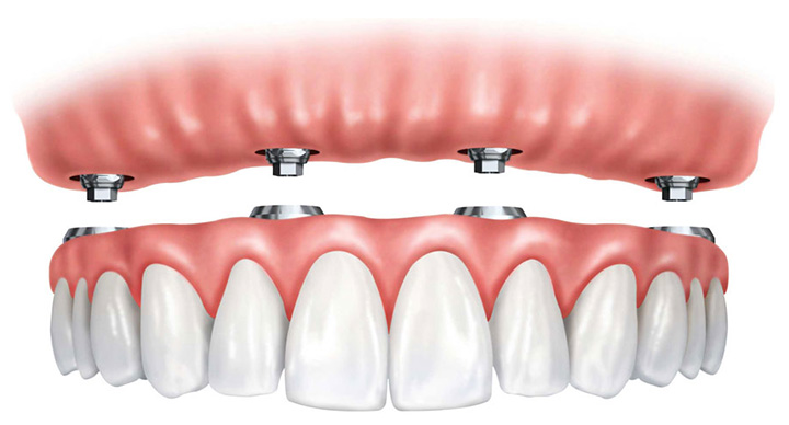 Denture on implants